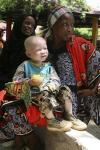 Gli albini di Tanzania e Burundi vivono nella paura